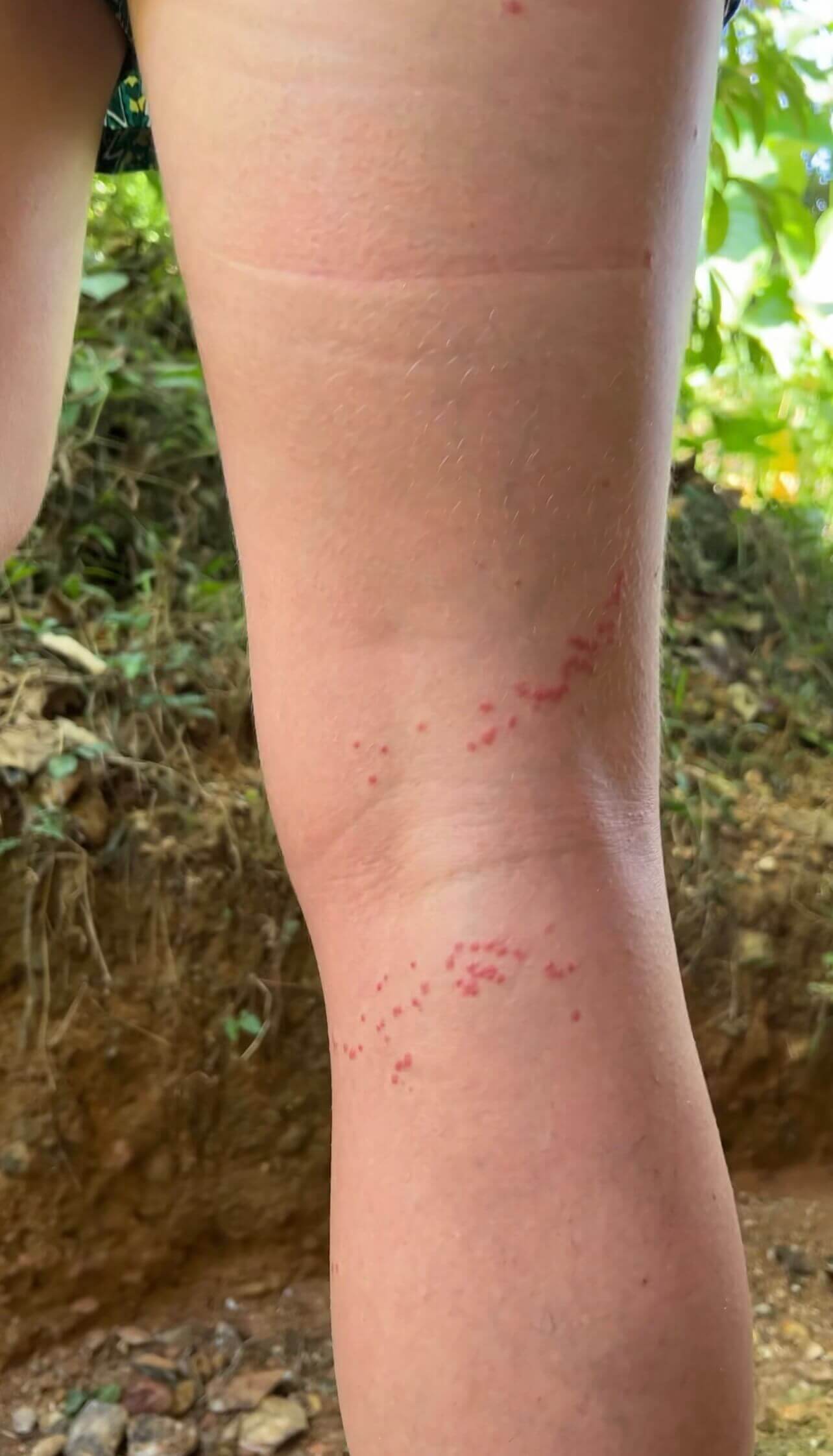 Sea Lice Sting